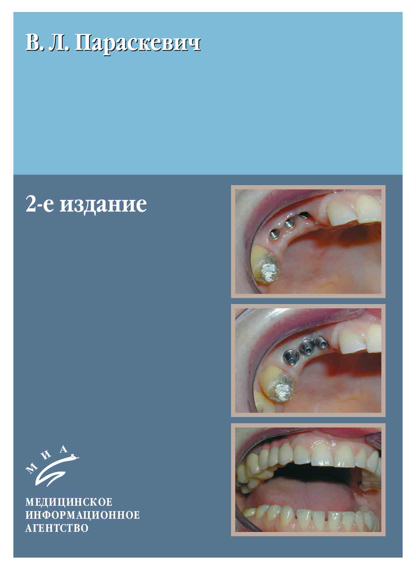 учебники по протезированию на имплантатах. зубная имплантация гветадзе книга. Biohorizons протезирование с опорой на импланты. дентальная имплантология майкл с блок. имплантация книги.
