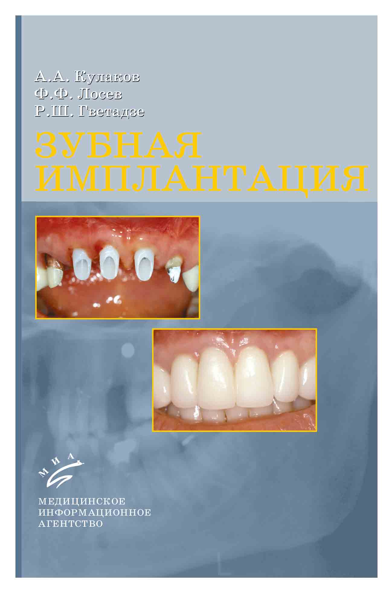 Имплант зуба волгоград. Книги для стоматологов. Учебник по имплантологии в стоматологии.